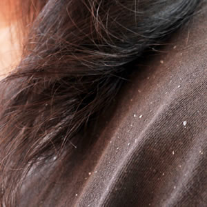 How to Deal with Dandruff at Home