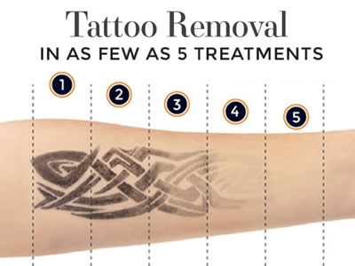 Dr. Yates – Tattoo Removal